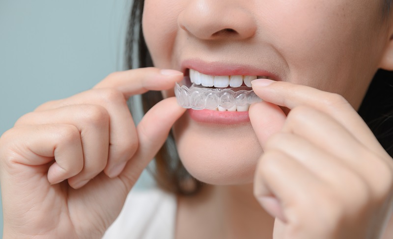 Woman,Wearing,Orthodontic,Silicone,Trainer.,Mobile,Orthodontic,Appliance,For,Dental Clear Aligner Service