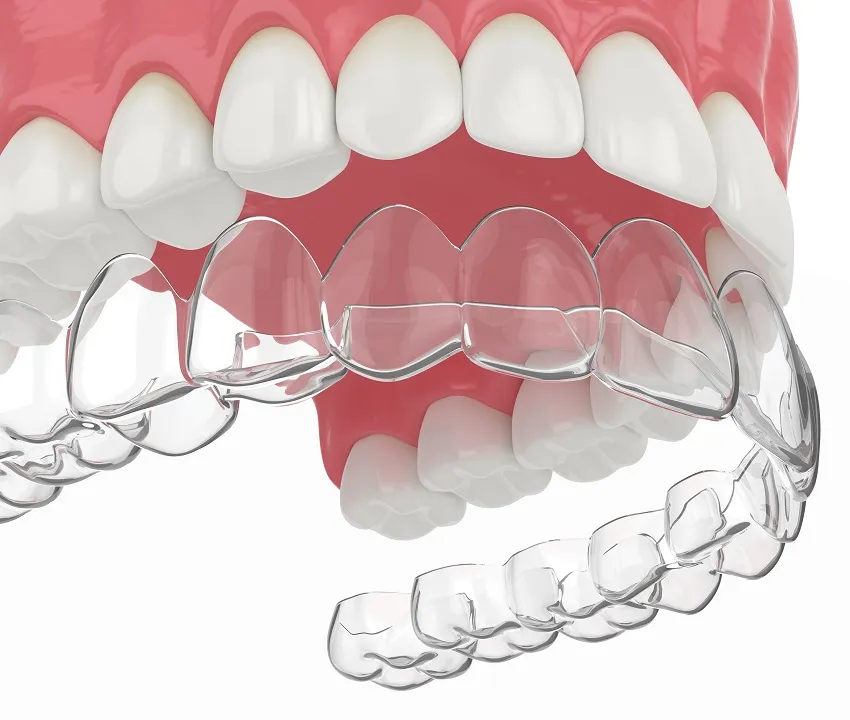 Clear Aligner