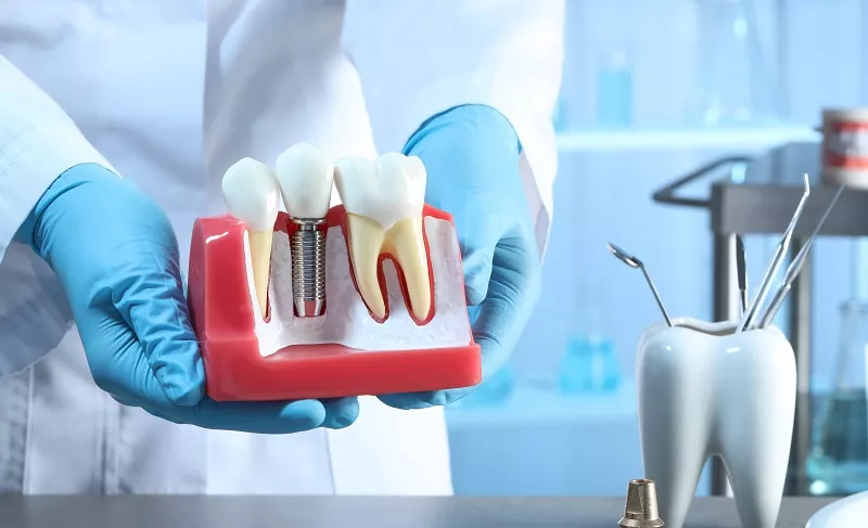 Dentist,Holding,Educational,Model,Of,Gum,With,Dental,Implant,Between dental implants form the foundation for the most reliable, long-lasting, and lifelike tooth replacements available, missing teeth
