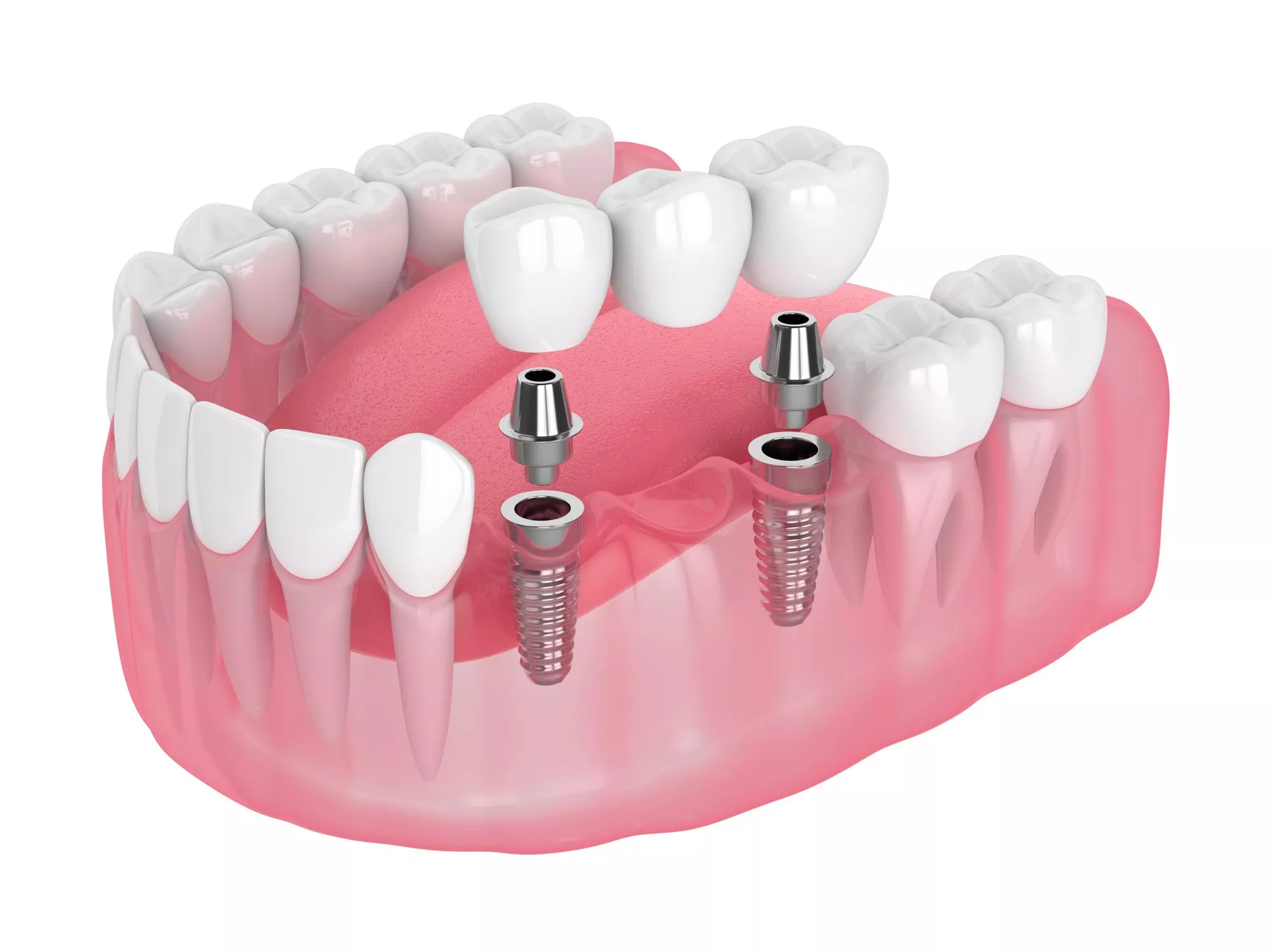 3d render of jaw with implants supported dental bridge Multiple Missing Teeth Image