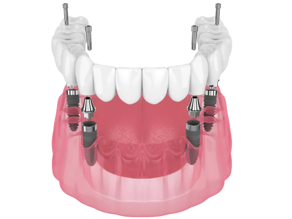 All-On-4-3D-Dental Implants all-on-4®, all on 3d dental implants