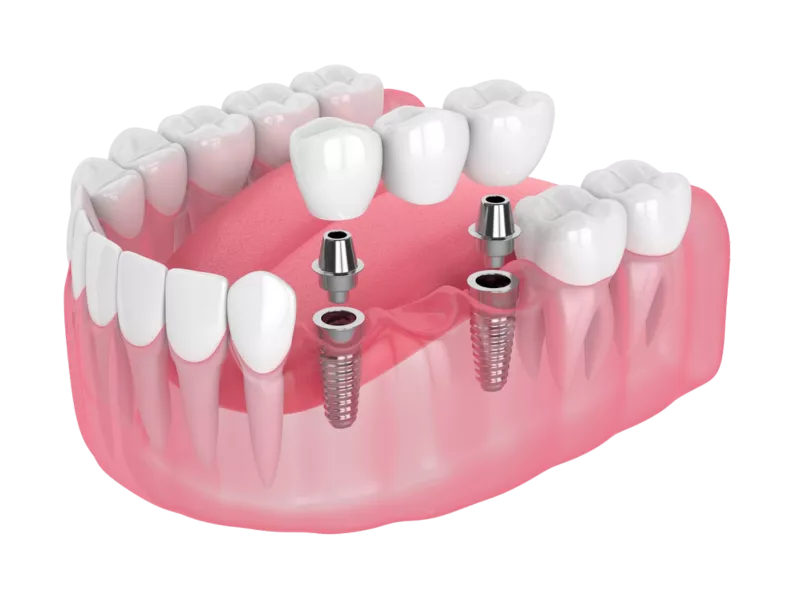 Multiple Missing Teeth multiple missing teeth, multiple missing teeth