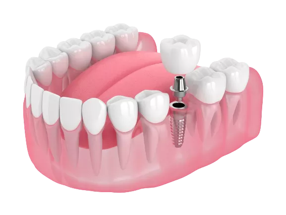 a one missing tooth, a