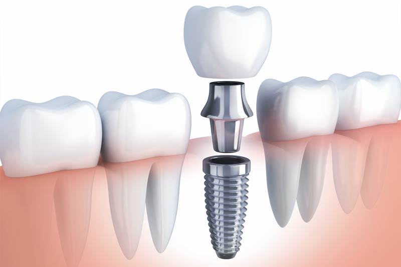 Implants Dentist in Lakewood