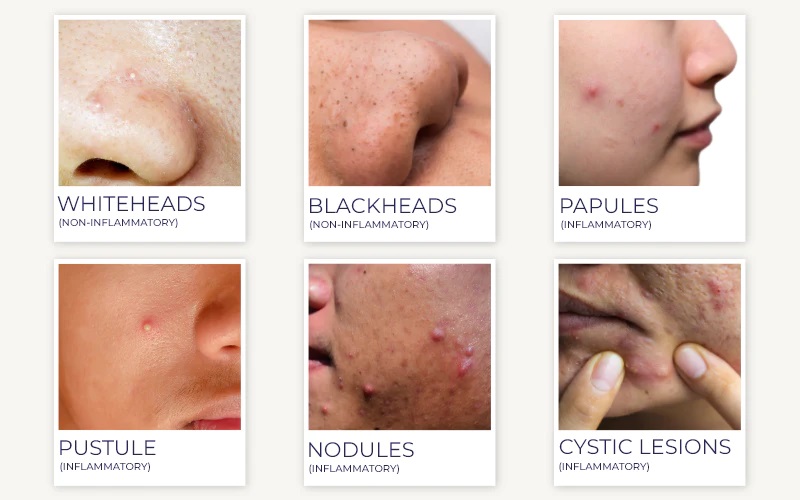 Different types of acne