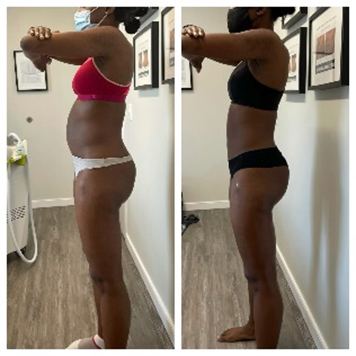 Skin Tightening Before and After 7