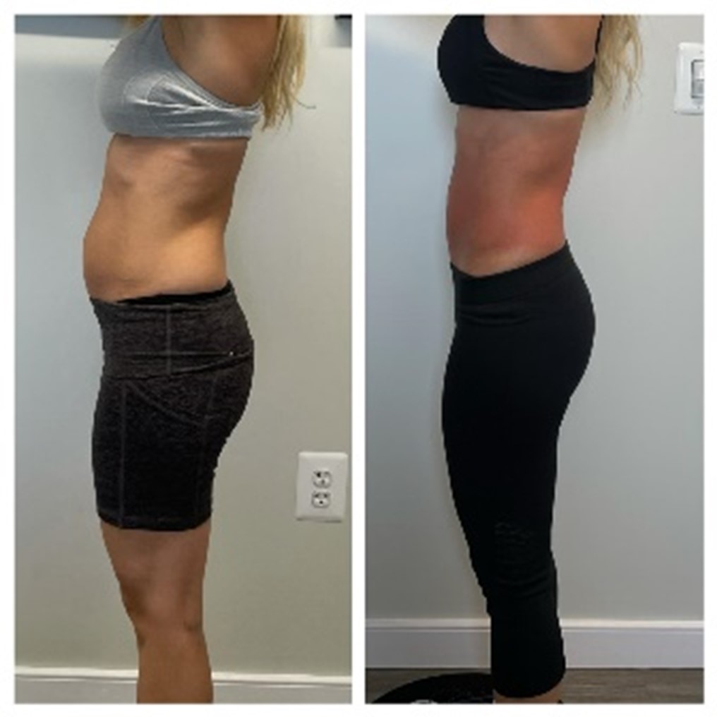 RF Skin Tightening Results