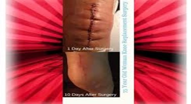 Customizing red light therapy treatments