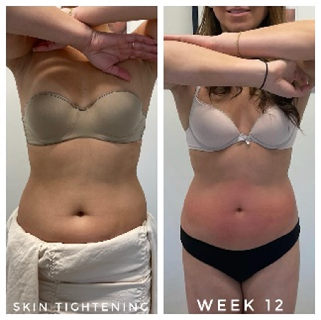 Aftercare and Results