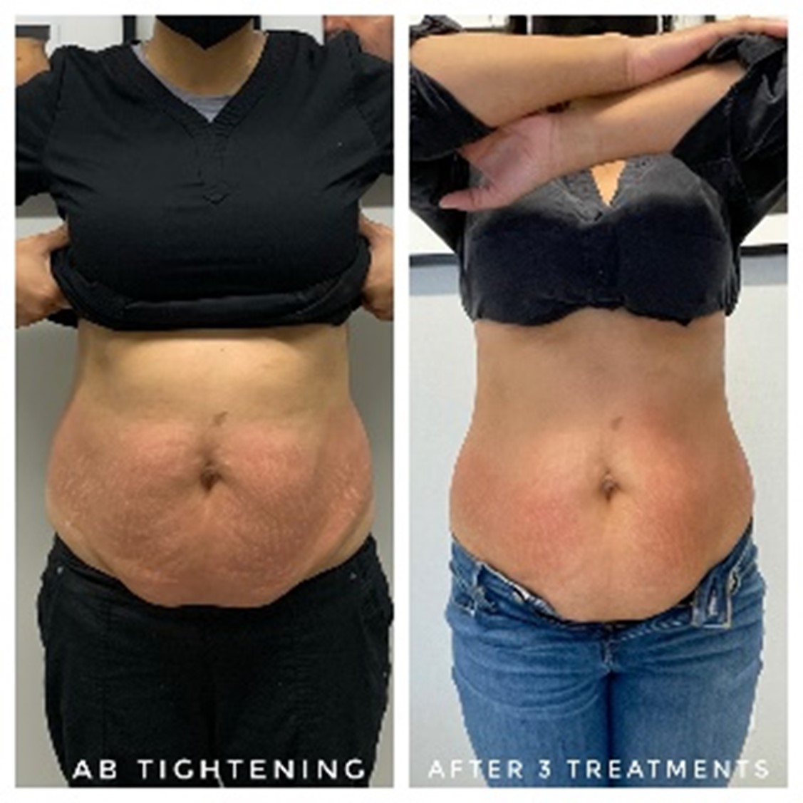 Skin Tightening Before and After 6