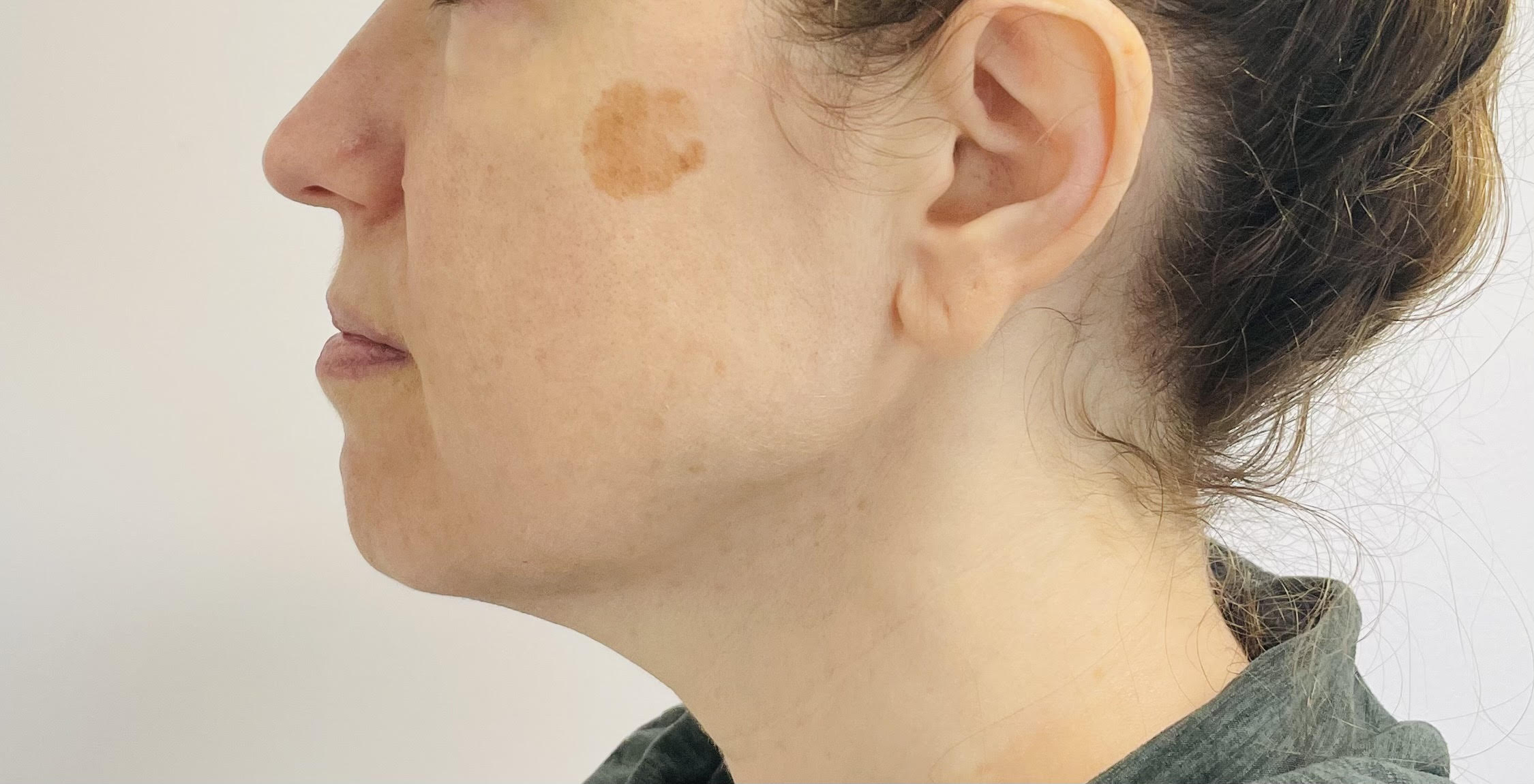Brown spot on cheek before IPL skin rejuvenation
