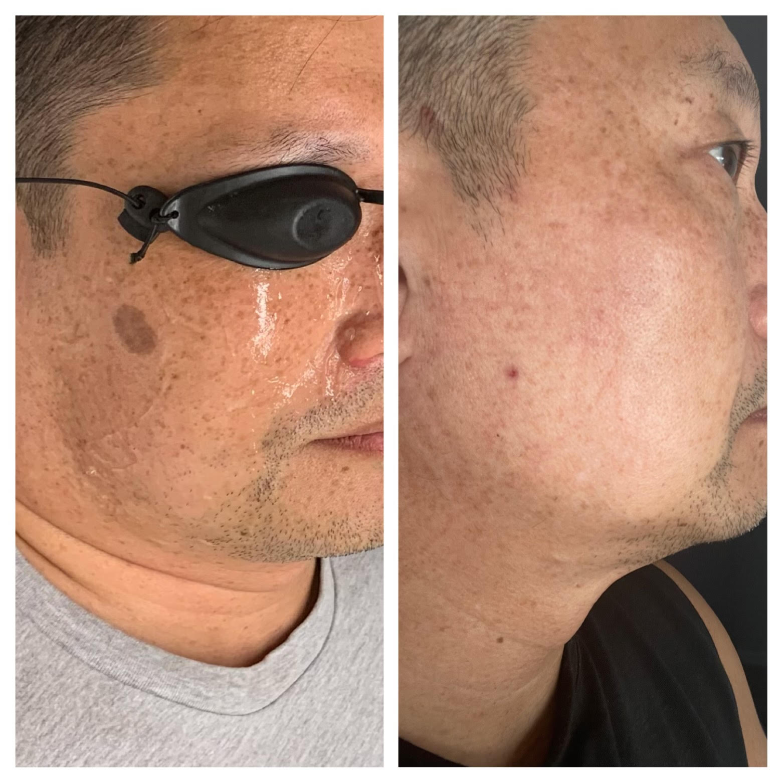 Before and after IPL skin rejuvenation for pigment spot
