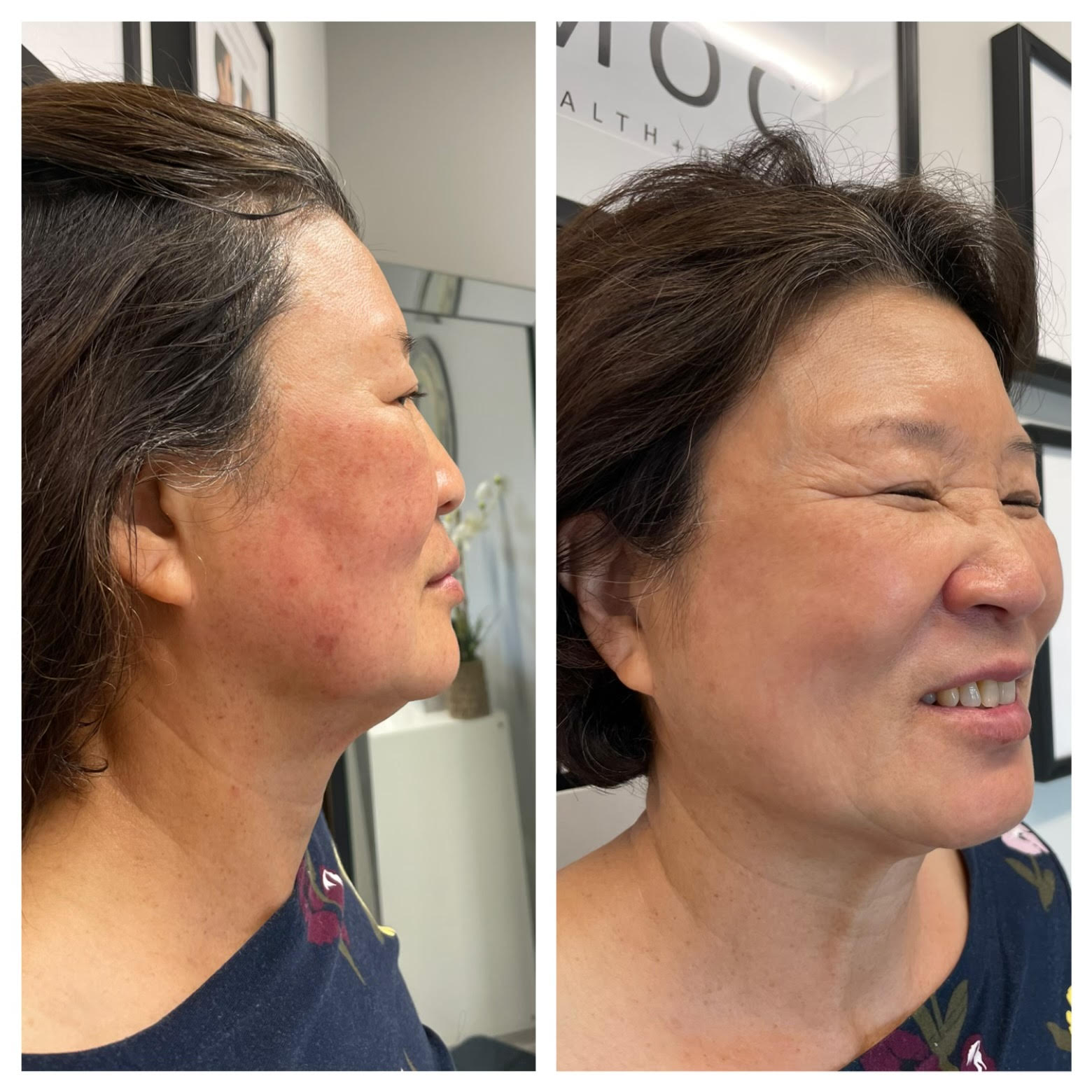Rosacea and redness before and after IPL