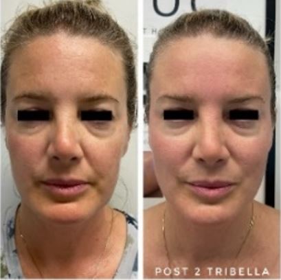 TriBella non invasive facelift before after 1