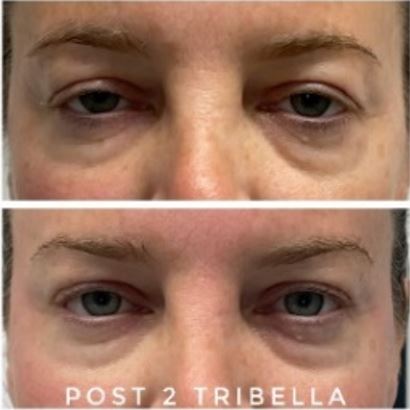 TriBella eye area before after