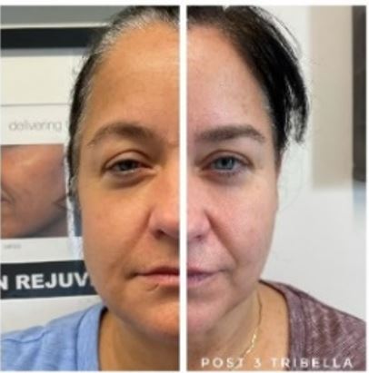 Before and after facial rejuvenation