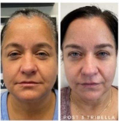 Before and after IPL skin tone improvement