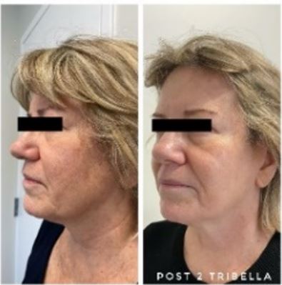 Profile improvement after photofacial series