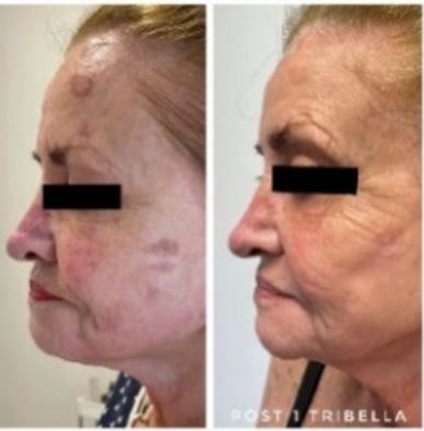 Side view Tribella result with even tone